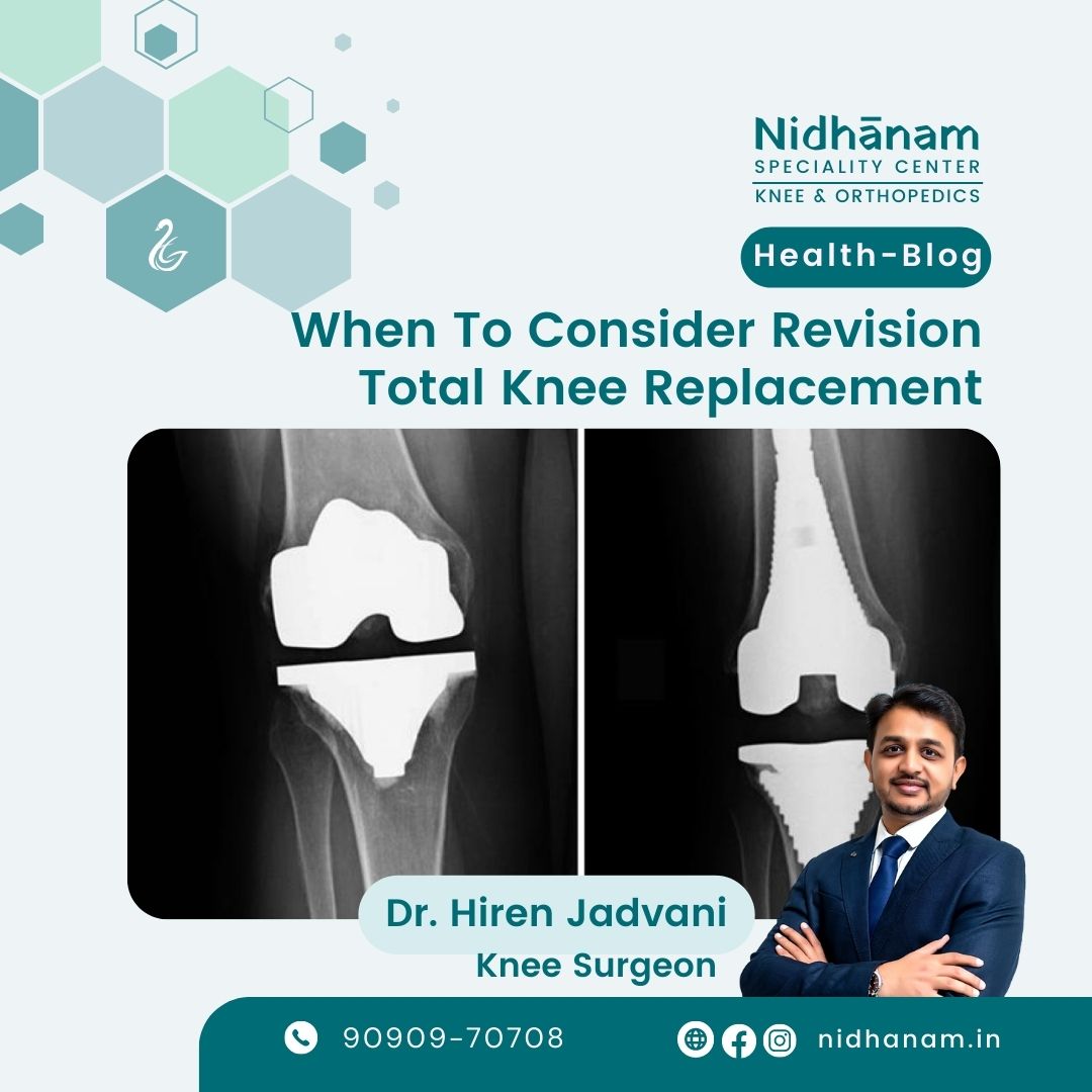 When to Consider Revision Total Knee Replacement