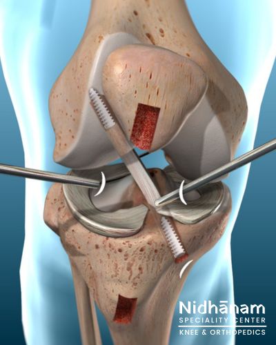 Nidhanam - ACL reconstruction in Surat